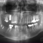 Burnaby Periodontist Bunraby Sinus lift IMPrESS Perio Implant Dr. Noroozi
