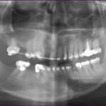 Burnaby Periodontist Bunraby Sinus lift IMPrESS Perio Implant Dr. Noroozi
