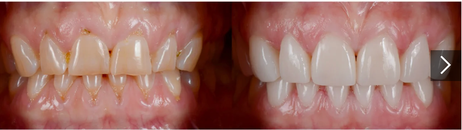 Before and After of Porcelain Veneers in Vancouver