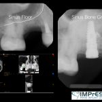 Sinus Lift Surgery to replace upper back teeth IMPrESS Perio Implant Center