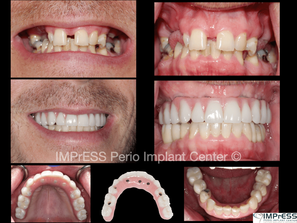 mile Makeover with Full Mouth Implants IMPrESS Perio Implant Center Burnaby BC Dr Noroozi