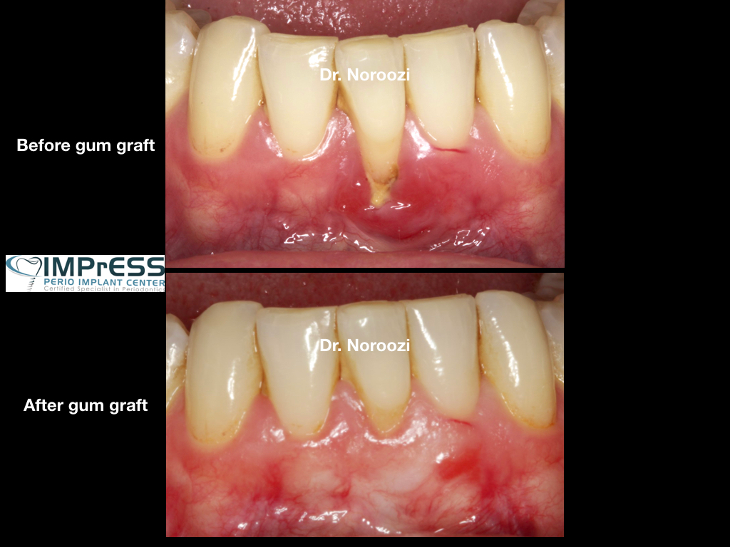best gum graft for treatment of receding gums Vancouver BC best periodontist Dr. Noroozi IMPrESS Perio
