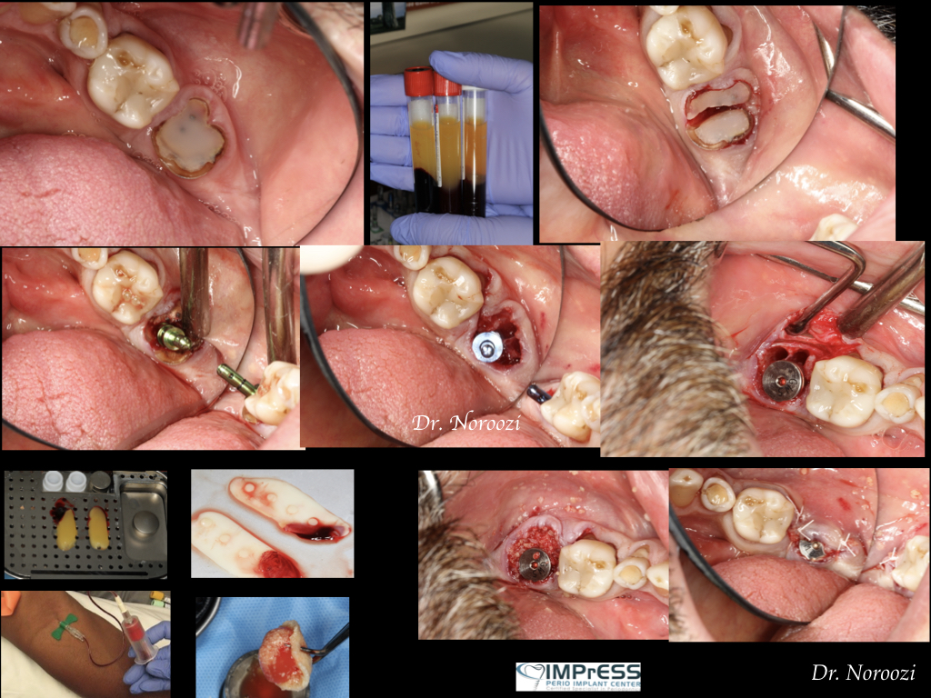 immediate implant placement in molar site Dr. Noroozi