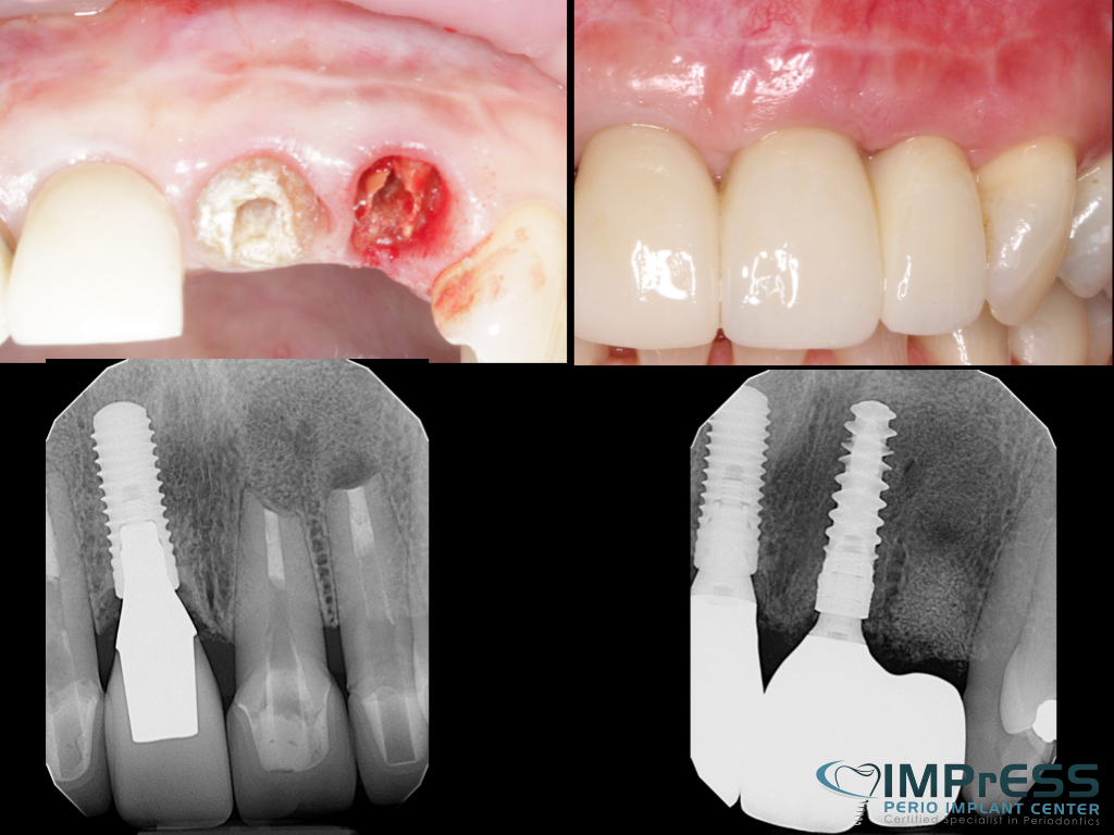 maxillary central and lateral incisor replacement with implant IMPrESS Perio Implant Center Dr. Noroozi Implant Specialist-Vancouver Burnaby BC.010
