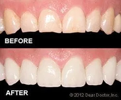 before and after veneers
